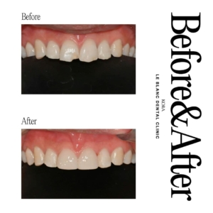 Le Blanc Dental Clinic_Dental veneers 1