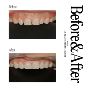 Le Blanc Dental Clinic_Dental veneers 3