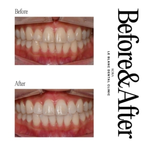 Le Blanc Dental Clinic_Teeth whitening 1