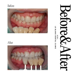Le Blanc Dental Clinic_Teeth whitening 2