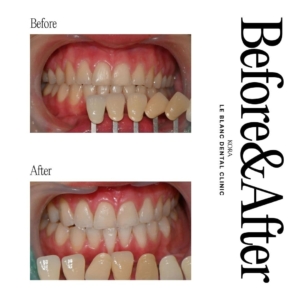 Le Blanc Dental Clinic_Teeth whitening 3
