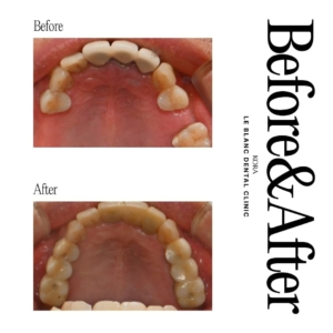 Le Blanc Dental Clinic_Dental implant surgery 1