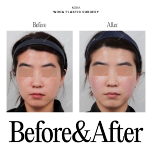 WOOA Plastic Surgery & Dermatology_Skin booster injections 1