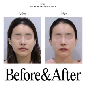 WOOA Plastic Surgery & Dermatology_Skin booster injections 3