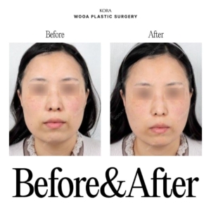 WOOA Plastic Surgery & Dermatology_Skin booster injections 5