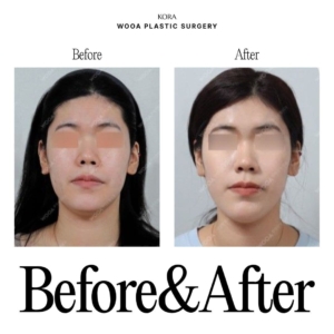 WOOA Plastic Surgery & Dermatology_Skin booster injections 6