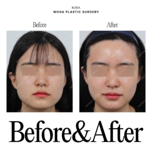 WOOA Plastic Surgery & Dermatology_Skin booster injections 8
