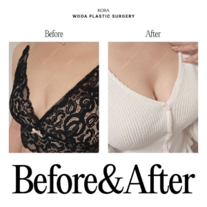 WOOA Plastic Surgery & Dermatology_Breast Augmentation 2