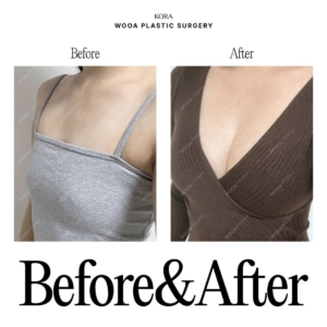WOOA Plastic Surgery & Dermatology_Breast Augmentation 3