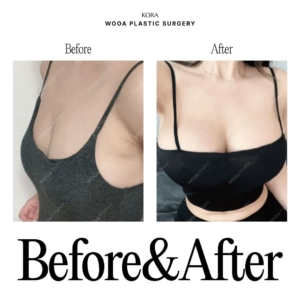 WOOA Plastic Surgery & Dermatology_Breast Augmentation 4