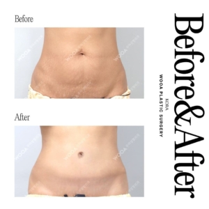 WOOA Plastic Surgery & Dermatology_Full abdominoplasty, Flank liposuction