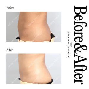 WOOA Plastic Surgery & Dermatology_Full abdominoplasty, Flank liposuction_side view