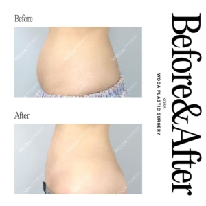 WOOA Plastic Surgery & Dermatology_Body liposuction 1