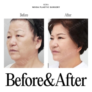 WOOA Plastic Surgery & Dermatology_Deep plane facelift & Neck lift 1 oblique view