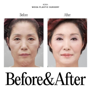 WOOA Plastic Surgery & Dermatology_Deep plane facelift & Neck lift 2