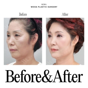WOOA Plastic Surgery & Dermatology_Deep plane facelift & Neck lift 2 oblique view