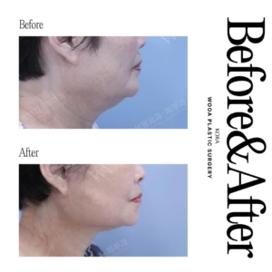 WOOA Plastic Surgery & Dermatology_Deep plane facelift & Neck lift 3 side view