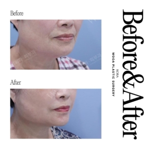 WOOA Plastic Surgery & Dermatology_Deep plane facelift & Neck lift 3 oblique view