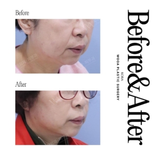 WOOA Plastic Surgery & Dermatology_Deep plane facelift & Neck lift 4 oblique view