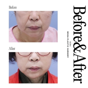 WOOA Plastic Surgery & Dermatology_Deep plane facelift & Neck lift 4