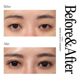 WOOA Plastic Surgery & Dermatology_Eye surgery 1