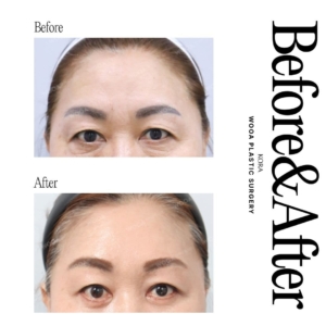 WOOA Plastic Surgery & Dermatology_Forehead lift 1