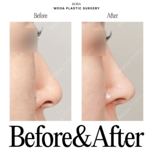 WOOA Plastic Surgery & Dermatology_Rhinoplasty 3.