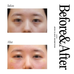 JRYN Clinic Seomyeon_Lower eye bag treatment 1 front view