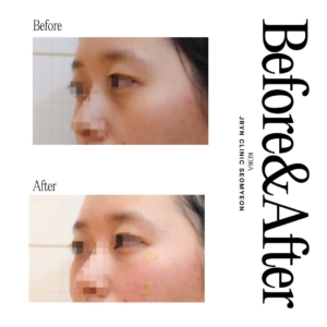 JRYN Clinic Seomyeon_Lower eye bag treatment 1 side view