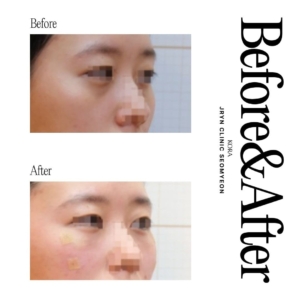 JRYN Clinic Seomyeon_Lower eye bag treatment 1 right view