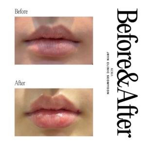 JRYN Clinic Seomyeon_Lip filler 1