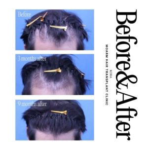 Moarm's FUE hair transplant 1