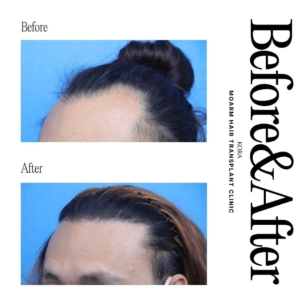 Moarm's FUE hair transplant 3