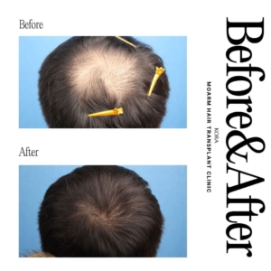 Moarm's FUE hair transplant 4