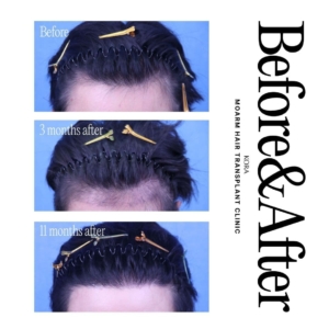 Moarm's FUE hair transplant 5