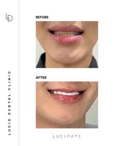 veneer before after3