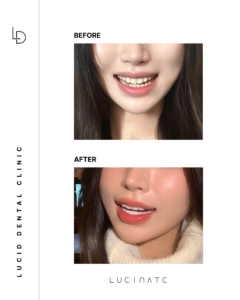 veneer before after
