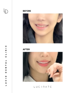 veneer before after2