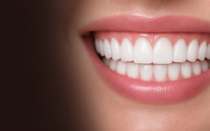 dental veneers