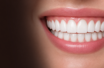 dental veneers
