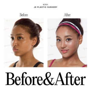 JK Plastic Surgery_Rhinoplasty