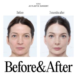 JK Plastic Surgery_Anti-aging surgery 6