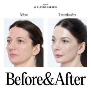 JK Plastic Surgery_Anti-aging surgery 6-2