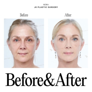JK Plastic Surgery_Anti-aging surgery 7