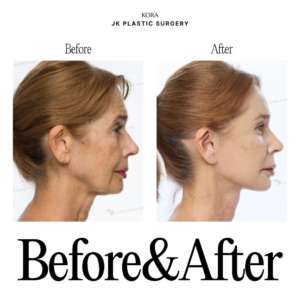 JK Plastic Surgery_Anti-aging surgery 8 -2