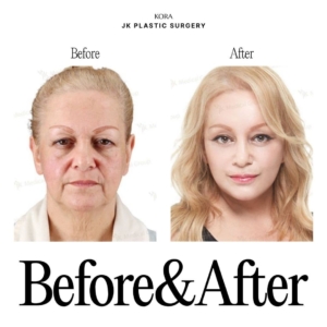 JK Plastic Surgery_Anti-aging surgery 2