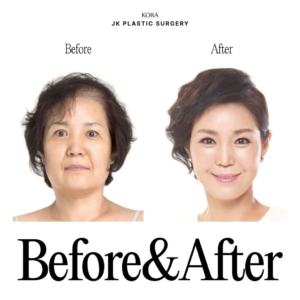 JK Plastic Surgery_Anti-aging surgery 3