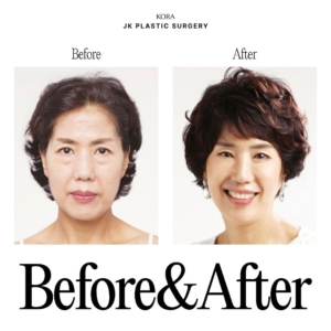JK Plastic Surgery_Anti-aging surgery 4