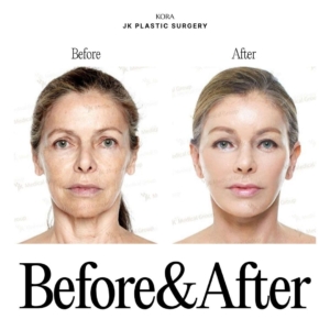 JK Plastic Surgery_Anti-aging surgery 5