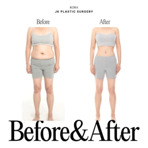 JK Plastic Surgery_Body liposuction, Tummy tuck 2